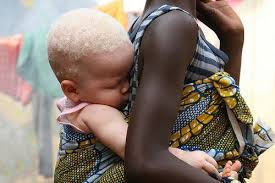 Tansania menschen afrikanische kunst afrikanische stämme afrikanische schönheit söhne kultur indianerfrauen indianer. Albinismus In Afrika Ein Model Berichtet Wie Sie Behandelt Wird Albino Mensch Afrika Kinder Dieser Welt