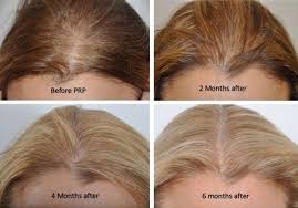 Bauman m.d., founder of bauman medical in boca raton, florida. Platelet Rich Plasma Md Skin Boutique