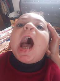 Hi all. I'm looking for some advice. My little boy had his first palate  surgery in September 2024 with Dr Theopold. It went really well and in  January of this year David