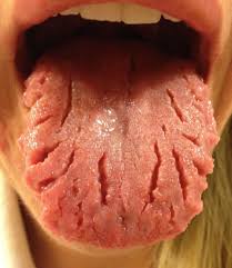Image result for Fissured tongue