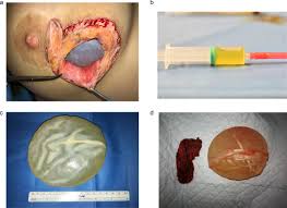 Breast augmentation, tummy tuck, or any other plastic surgery options . Preliminary Outcomes And Comparison Of Polytech Polytxt And Mesmosensitive Breast Implants With Focus On Late Seroma Single Surgeon Retrospective Cohort Study On 621 Consecutive Aesthetic Breast Surgery Cases Journal Of Plastic Reconstructive