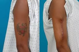 Today, there are many new can permanent tattoo be removed? Can Tattoos Be Removed And Will I Look Normal Again Quora