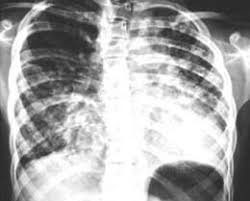 Cuando la fibrosis pulmonar no tiene causa fibrosis pulmonar difusa.frecuente la fibrosis pulmonar idiopática fpi, con una incidencia de 1, 6. Fibrosis Pulmonar Idiopatica Ecured