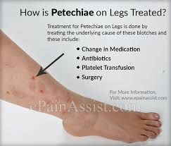 People with the disease have too few platelets in the blood. Mild Petechiae On Legs Pet S Gallery