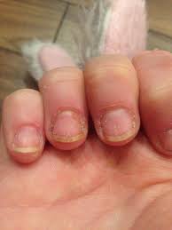 11 nail art ideas to make short, stubby nails look longer. How To Fix And Grow Out Bitten Nails B C Guides