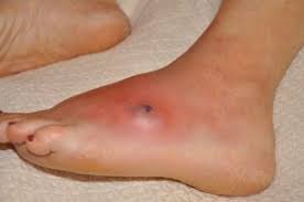 Image result for Spider Bite