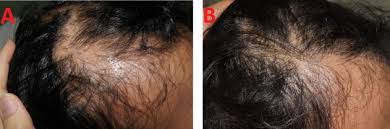 However, if patients don't regrowth hair with these treatments, steroid injections are often a very good option. Platelet Rich Plasma Combined With Intralesional Triamcinolone Acetonide For The Treatment Of Alopecia Areata A Case Report Sciencedirect
