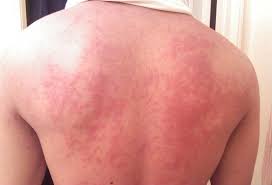 Image result for zika virus