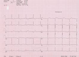 In form einer ballondilatation) wissenschaftlich nicht belegt. An Nstemi Case Due To A Severe Lm Calcific Sub Occlusive Stenosis