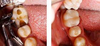 Composite Fillings West Byfleet Cosmetic Dentist