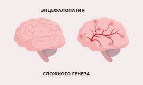 Энцефалопатия — это общий термин, который означает болезнь мозга, повреждение или неправильную работу. Encefalopatiya Slozhnogo Geneza Chto Takoe Encefalopatiya Slozhnogo Geneza S Levostoronnim Gemiparezom