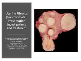 Uterine Fibroids Leiomyomata Investigations And Treatment