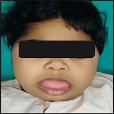 Management of Macroglossia Secondary to Beckwith-Weidmann Syndrome in a  Pediatric Patient: A Case Report