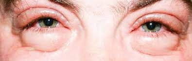 How To Get Rid Of Puffy Red Swollen Eyes From Crying Swollen Eyes Puffy Eyes Puffy Eyes Remedy