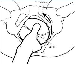 Image result for Manual Rotation in Occipitoposterior Presentation
