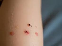 Image result for infected tick bite