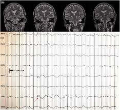 Manhwa that mans epilepsy (bahasa indonesia) merupakan manhwa18 karya active volcano yang bergenre adult, comedy, harem, manhwa, mature, romance, seinen. Spermatorrhea In A Chinese Patient With Temporal Lobe Epilepsy A Case Report Abstract Europe Pmc