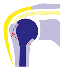 Gilchrist Verband Gelenk Klinik De