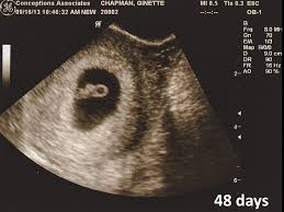 Womb With A View Ultrasound Images Mitchtobin Com Baby Ultrasound Baby Photos First Ultrasound