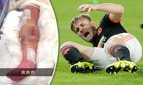 Luke underwent surgery for his injury and will remain in hospital in eindhoven to continue his early recovery. Snapped Man Utd Star Luke Shaw Posts Graphic Picture Of Leg Injury After Surgery Football Sport Express Co Uk