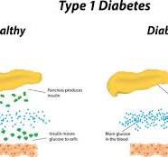 Type 1 diabetes: MedlinePlus Genetics