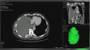 We did not find results for: Ai Technology Used To Track Asbestos Cancer Tumours Bbc News