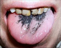 These spots can spread from back of the tongue to the middle part. Black Hairy Tongue The American Journal Of Medicine