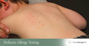 Image result for Allergy Screening