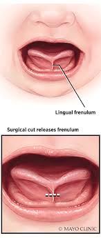 Snipping An Infants Tongue Tie Can Improve Breastfeeding