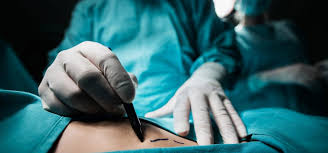 Liposuction Surgical Procedures Cubaheal Caribbean Fat Removal Surgical