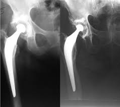 Risque de compression m�dullaire parfois. La Prothese De Hanche Cimentee Metal Polyethylene En 22 2 Mm Est Elle Un Gold Standard Resultats D Une Serie De 105 Protheses Primaires Au Recul Minimal De 10 Ans Sciencedirect