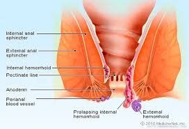 Bowel cancer is the umbrella term for cancer that develops in the large bowel. Difference Between Piles And Fistula And Fissure India Explained