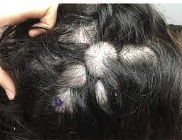 And still others choose one of the treatments available to prevent further hair loss or restore growth. Research In Hiv On Twitter The Presence Of Other Sexually Transmitted Infections Stis May Also Increase A Person S Risk Of Hair Loss Stis Such As Syphilis Gonorrhea And Herpes Often Co Occur In