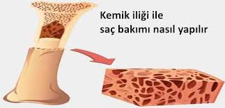 Sac Dokulmesi Icin Kemik Iligi Bakimi Nasil Yapilir Vipbakim Kemik Iligi Sac Dokulmesi Sac