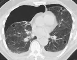 Check spelling or type a new query. An 83 Year Old Man With Bilateral Spontaneous Pneumothoraces And Multiple Cysts Chest
