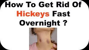 How To Get Rid Of Hickeys Fast Overnight -How To Hide Hickies Neck Hickey -  Youtube