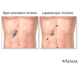 We did not find results for: Gallbladder Removal Series Aftercare Medlineplus Medical Encyclopedia