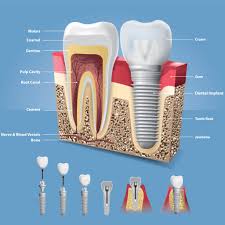 Image result for dental implant