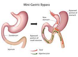 Some variations of the procedure do a modified gastric sleeve. Tijuana Gastric Sleeve Vs Mini Gastric Bypass Surgery Bariatric Procedures