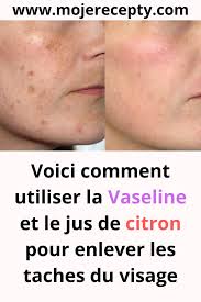 Voici Comment Utiliser La Vaseline Et Le Jus De Citron Pour Enlever Les Taches Du Visage Rougeurs Visage Vaseline Visage Tache Brune Visage
