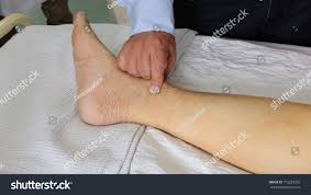 Image result for Edema Exam