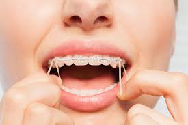 An overbite is when your upper teeth overlap your bottom teeth when you close your mouth. How To Put Rubber Bands On Braces Premier Orthodontics