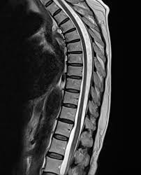 Image result for Myelitis