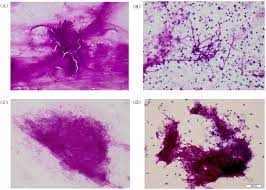 Fungal disease caused by the mold aspergillus, ranging from hypersensitivity to invasive infection. Cytomorphology Of Aspergillus In Sputum And Bronchial Brushing Samples Download Scientific Diagram