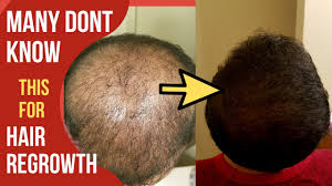 Started taking spirulina and chlorella for benefits of general health, healthy hair and hair growth. Hair Regrowth Remedies 2021 Part 2 Baldness Hair Growth Hair Loss Cure Herbal Hair Growth Youtube