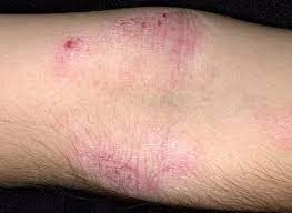 Calcinevrin inhibitors in pediatric atopic dermatitis: Atopische Dermatitis Ekzem Hauterkrankungen Msd Manual Ausgabe Fur Patienten