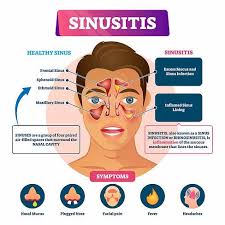 Normal aging can cause a loss of smell too, particularly after age 60. 6 Common Symptoms Of Chronic Sinusitis