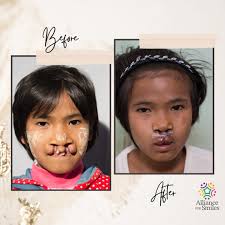 In February 2019, Yan Lu and her mom traveled 5 hours by bus to Myitkyina,  Myanmar for a chance at something life-changing—a free cleft surgery,  thanks to Alliance for Smiles. Yan's teacher,