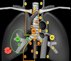 The Radiology Assistant Lung Cancer Tnm 8th Edition