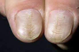 Onicólisis , onicolisis , onicólisis (trastorno) , onicólisis , separación del lecho ungueal , onicolisis. Deformaciones Y Distrofias De Las Unas Trastornos Dermatologicos Manual Msd Version Para Profesionales